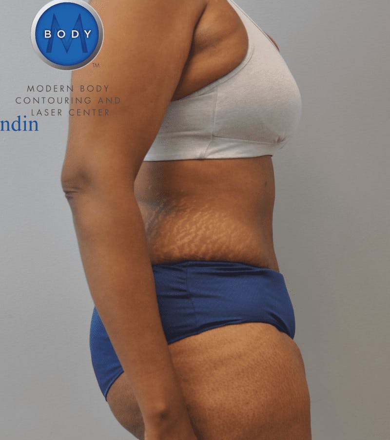 Tummy Tuck Before & After Gallery - Patient 55345739 - Image 4