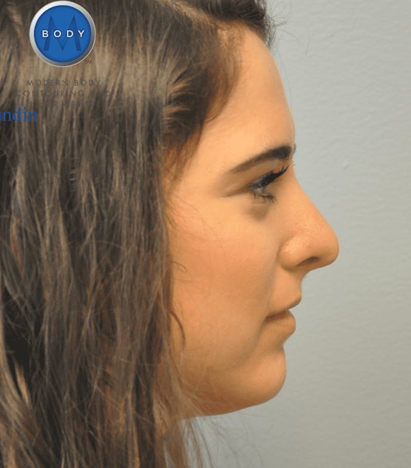 Rhinoplasty Before & After Gallery - Patient 55345742 - Image 8