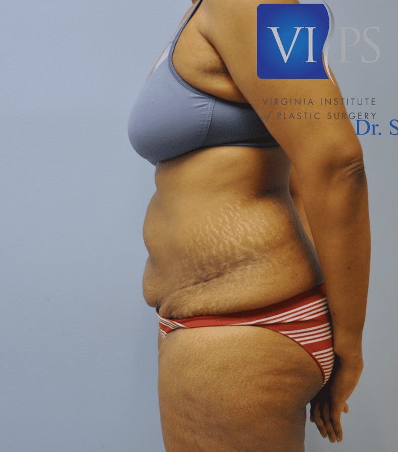 Tummy Tuck Before & After Gallery - Patient 55345739 - Image 5