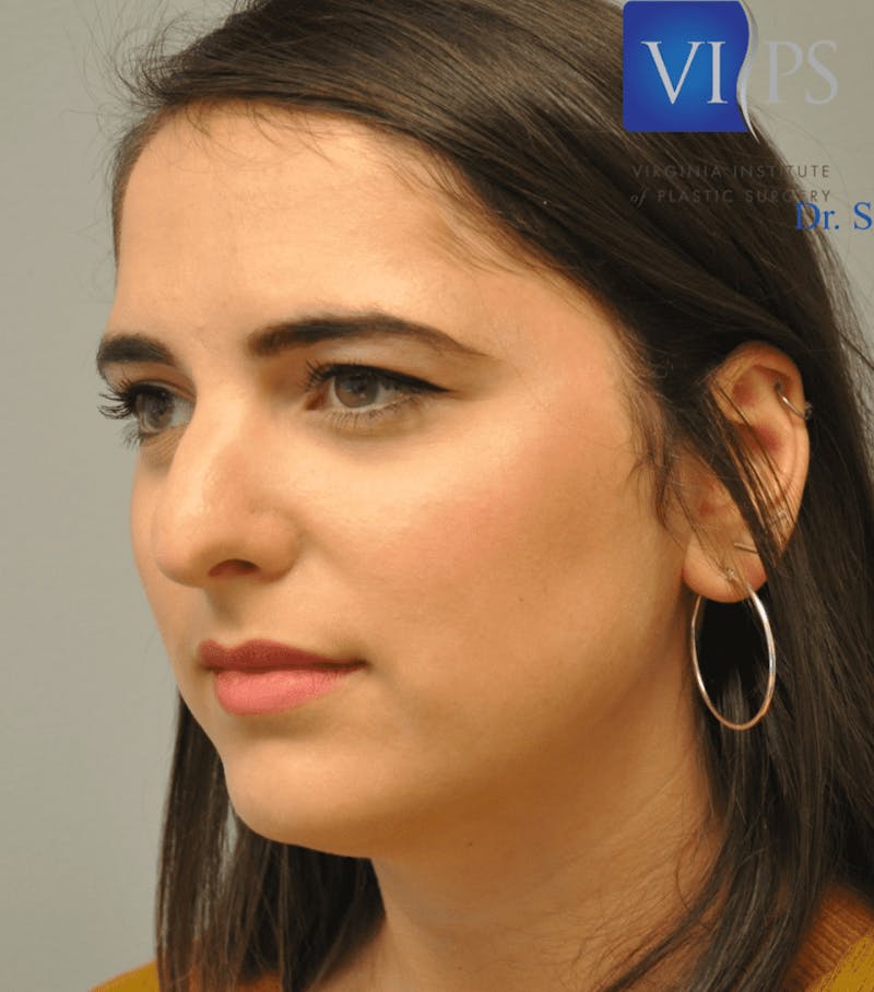 Rhinoplasty Before & After Gallery - Patient 55345742 - Image 9