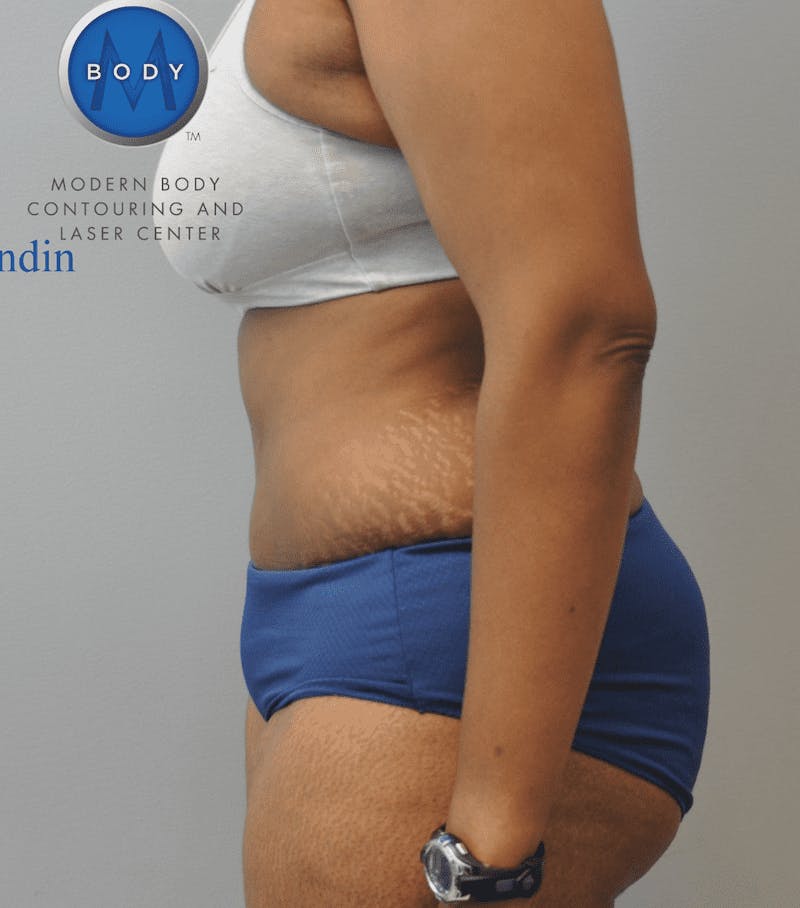 Tummy Tuck Before & After Gallery - Patient 55345739 - Image 6