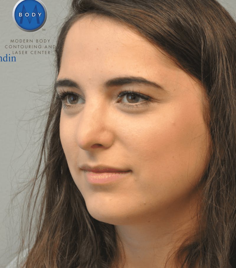 Rhinoplasty Before & After Gallery - Patient 55345742 - Image 10