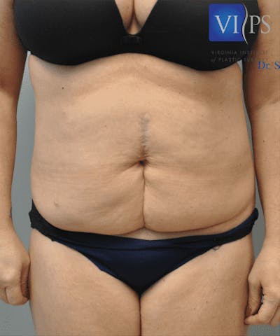 Tummy Tuck Before & After Gallery - Patient 55345744 - Image 1