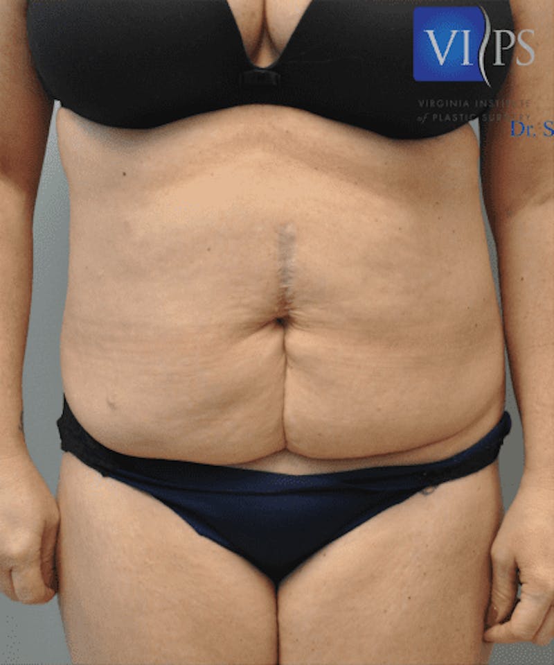 Tummy Tuck Before & After Gallery - Patient 55345744 - Image 1