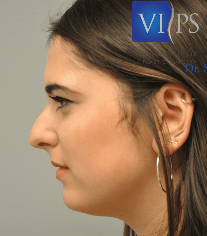 Rhinoplasty Before & After Gallery - Patient 55345742 - Image 11