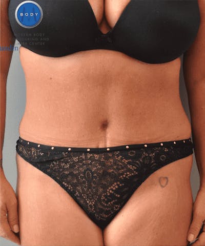 Tummy Tuck Before & After Gallery - Patient 55345744 - Image 2