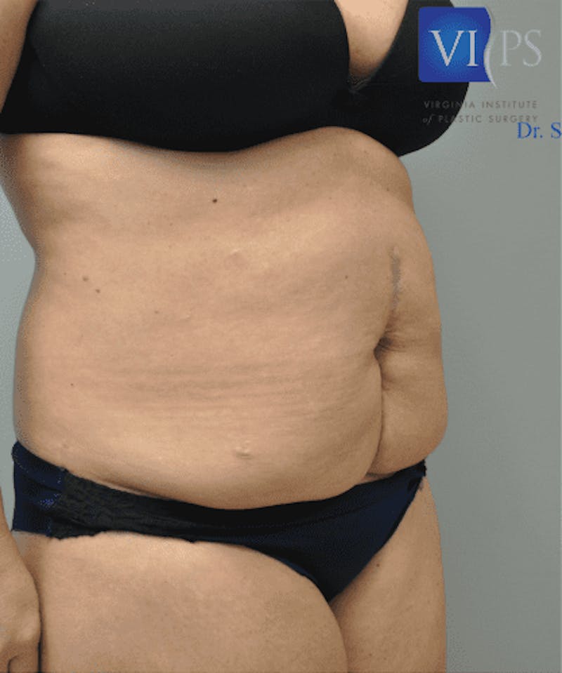 Tummy Tuck Before & After Gallery - Patient 55345744 - Image 3