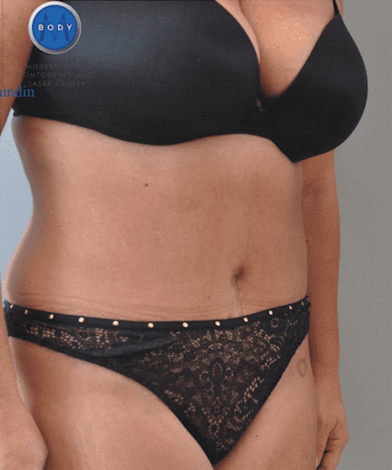Tummy Tuck Before & After Gallery - Patient 55345744 - Image 4