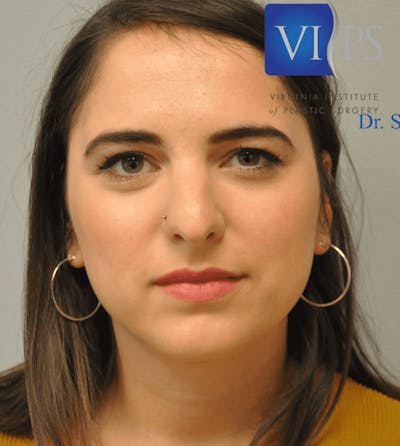 Rhinoplasty Before & After Gallery - Patient 55345747 - Image 1