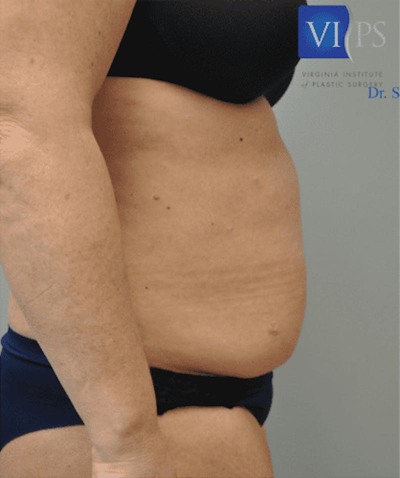 Tummy Tuck Before & After Gallery - Patient 55345744 - Image 5