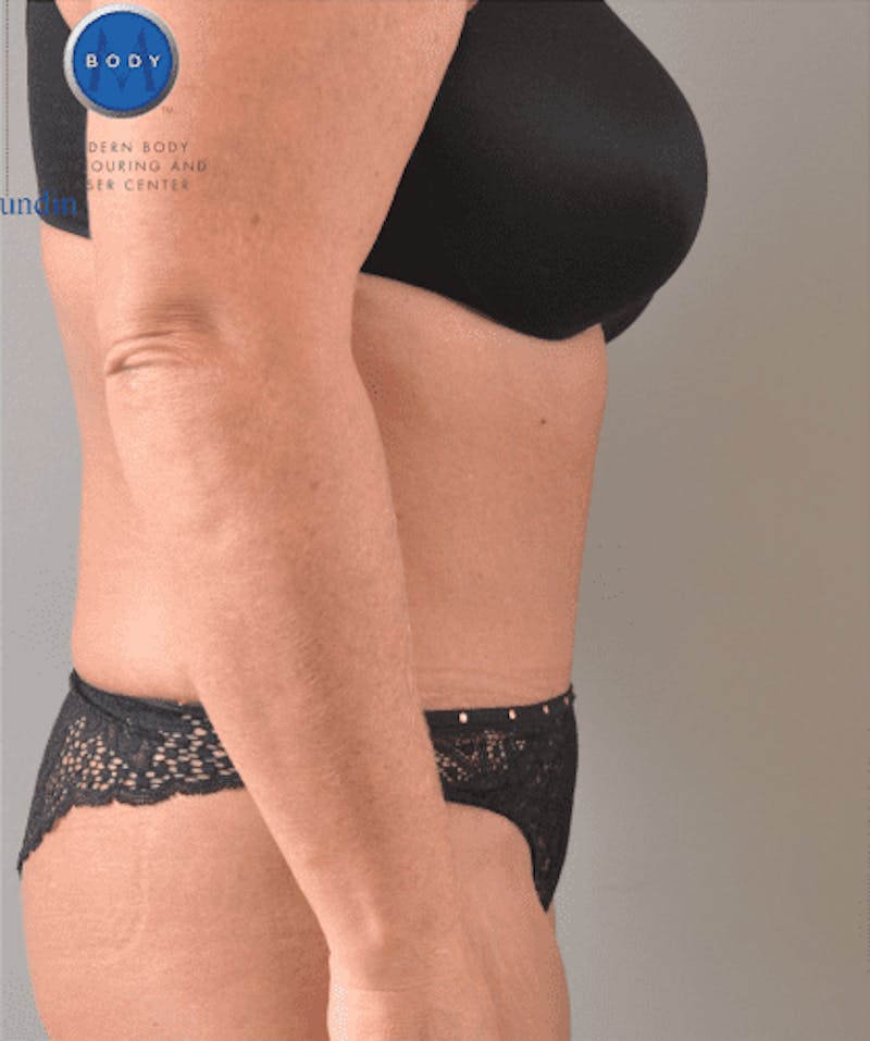 Tummy Tuck Before & After Gallery - Patient 55345744 - Image 6