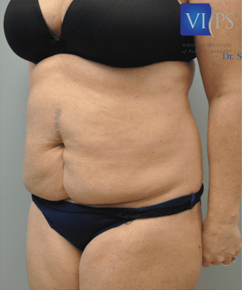 Tummy Tuck Before & After Gallery - Patient 55345744 - Image 7