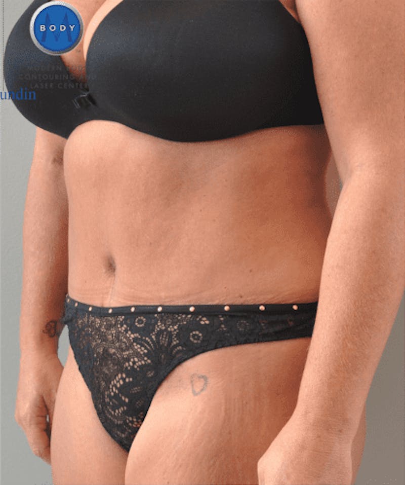 Tummy Tuck Before & After Gallery - Patient 55345744 - Image 8