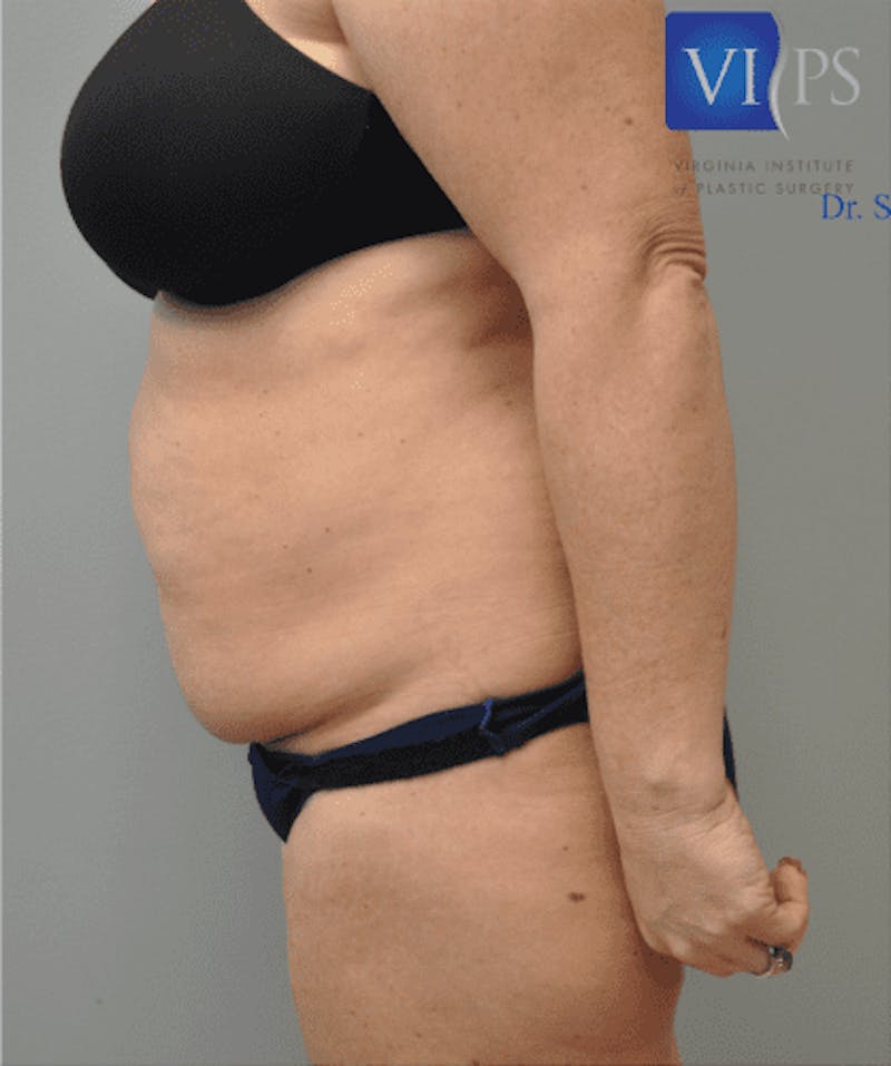 Tummy Tuck Before & After Gallery - Patient 55345744 - Image 9