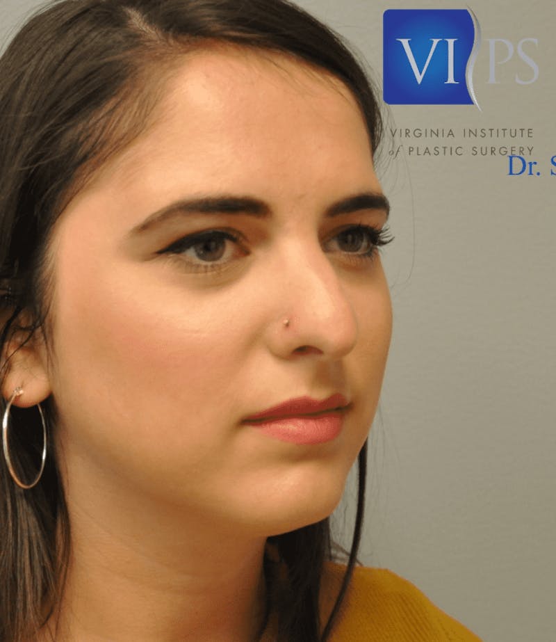 Rhinoplasty Before & After Gallery - Patient 55345747 - Image 5