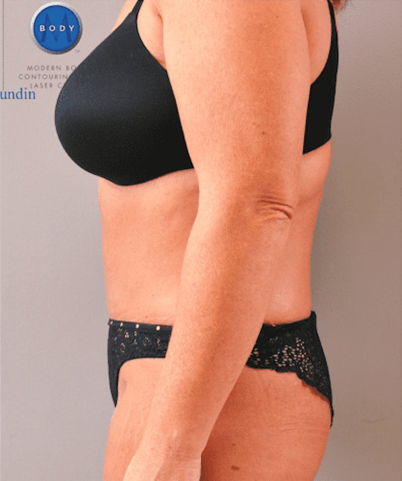 Tummy Tuck Before & After Gallery - Patient 55345744 - Image 10