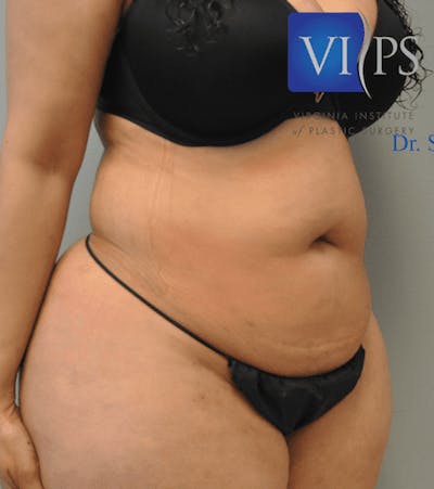 Tummy Tuck Before & After Gallery - Patient 55345748 - Image 1