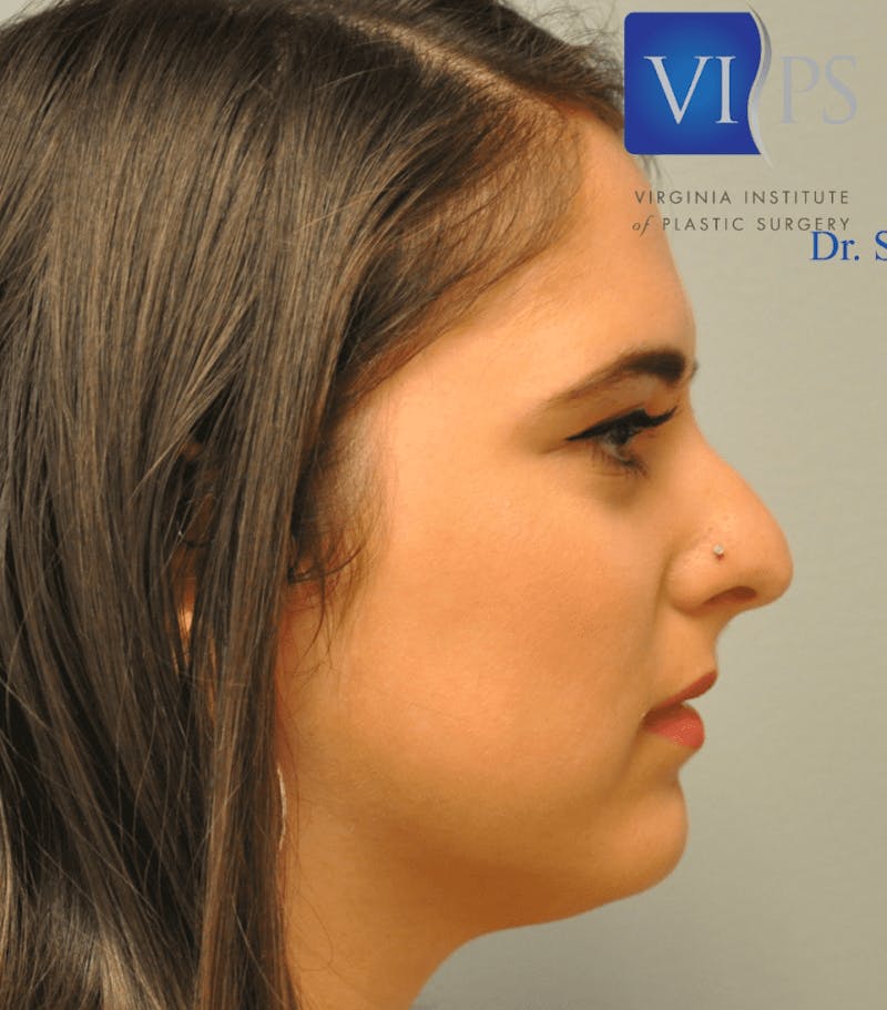 Rhinoplasty Before & After Gallery - Patient 55345747 - Image 7