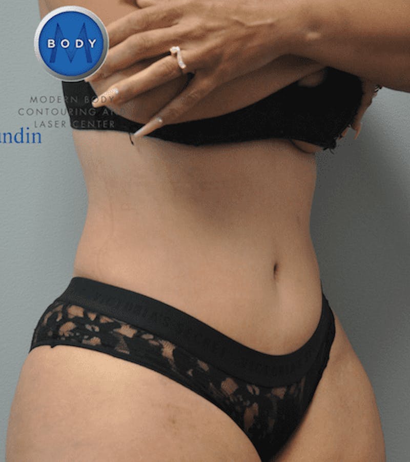 Tummy Tuck Before & After Gallery - Patient 55345748 - Image 2