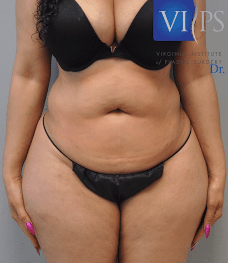 Tummy Tuck Before & After Gallery - Patient 55345748 - Image 3