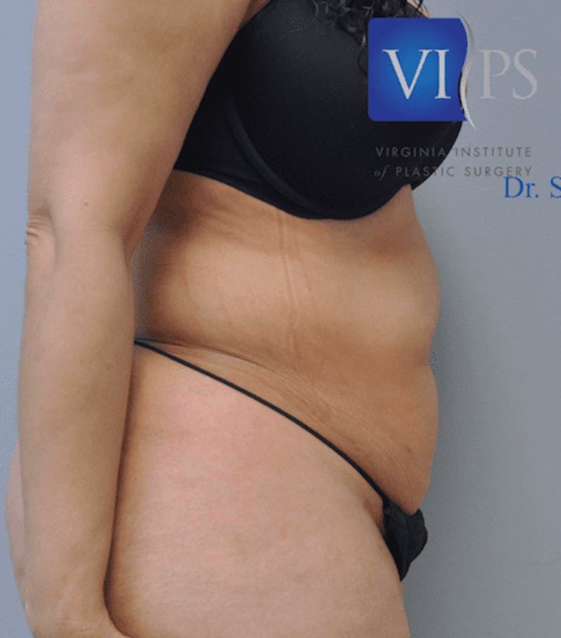 Tummy Tuck Before & After Gallery - Patient 55345748 - Image 5