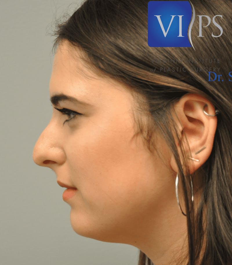 Rhinoplasty Before & After Gallery - Patient 55345747 - Image 11