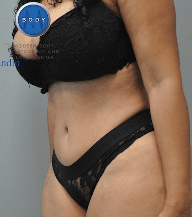 Tummy Tuck Before & After Gallery - Patient 55345748 - Image 8