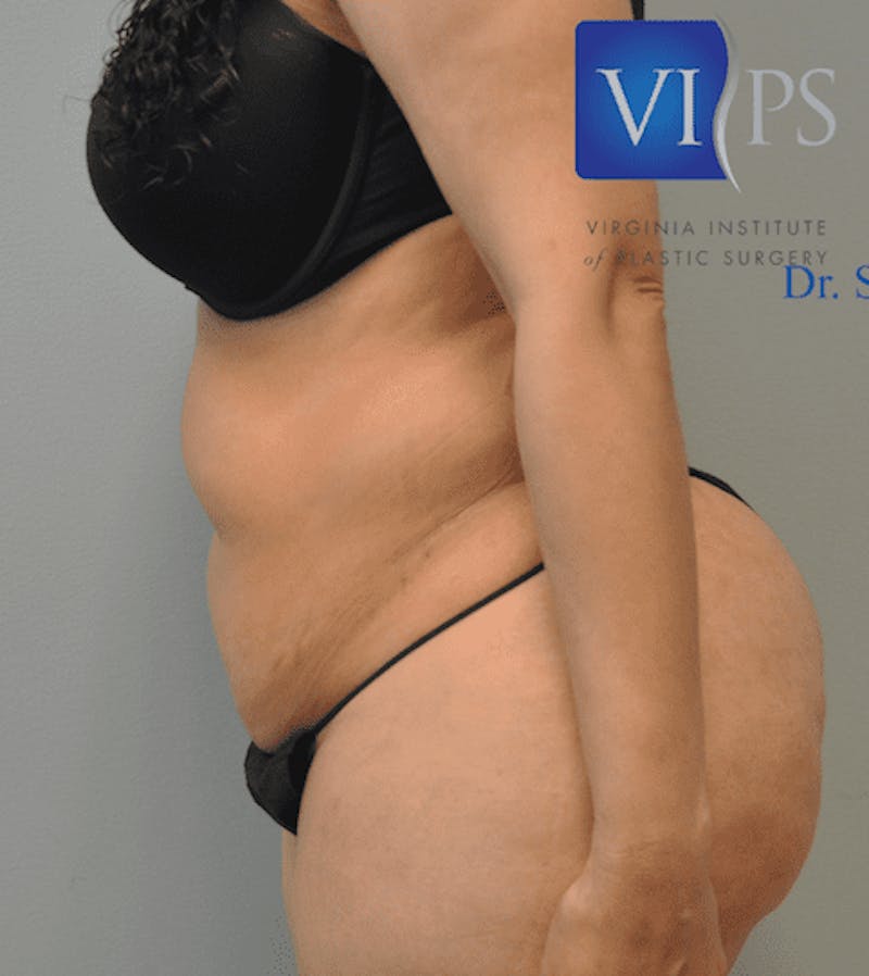 Tummy Tuck Before & After Gallery - Patient 55345748 - Image 9