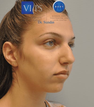 Rhinoplasty Before & After Gallery - Patient 55345754 - Image 1