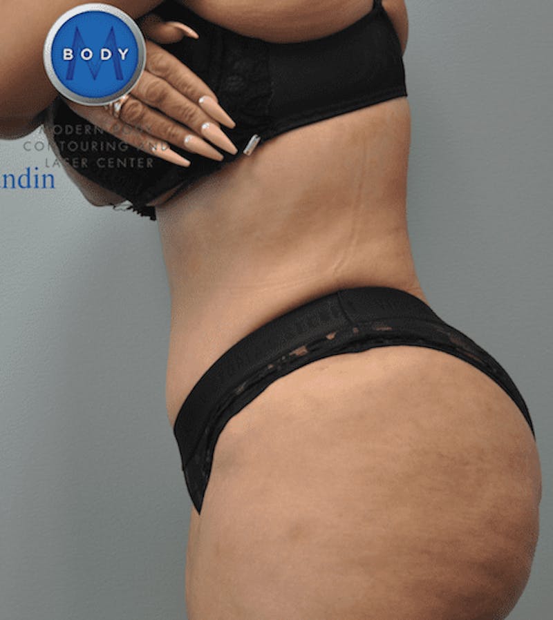 Tummy Tuck Before & After Gallery - Patient 55345748 - Image 10