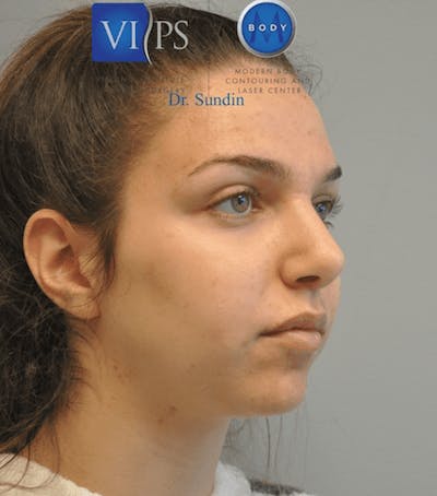 Rhinoplasty Before & After Gallery - Patient 55345754 - Image 2