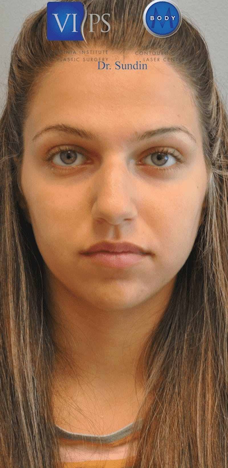 Rhinoplasty Before & After Gallery - Patient 55345754 - Image 3
