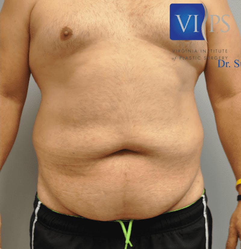 Tummy Tuck Before & After Gallery - Patient 55345753 - Image 1