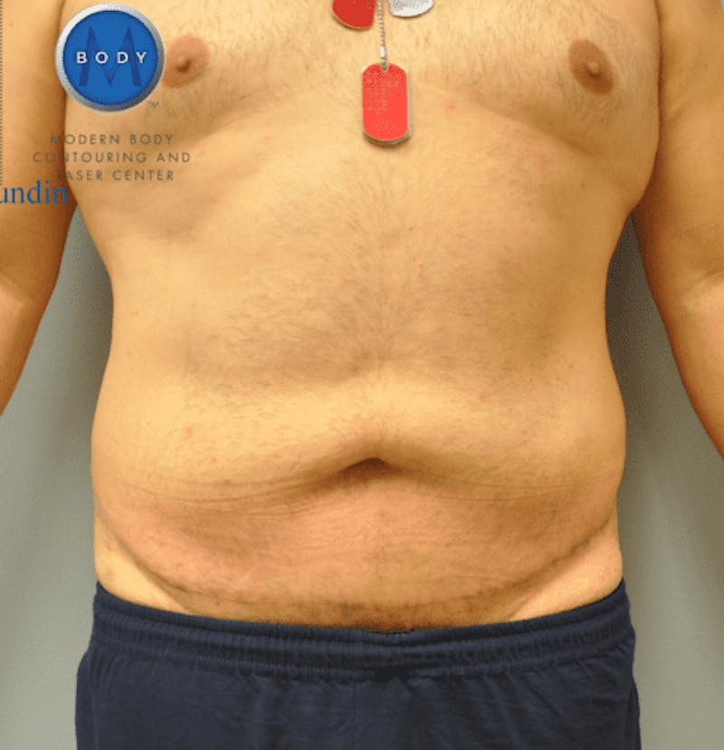 Tummy Tuck Before & After Gallery - Patient 55345753 - Image 2