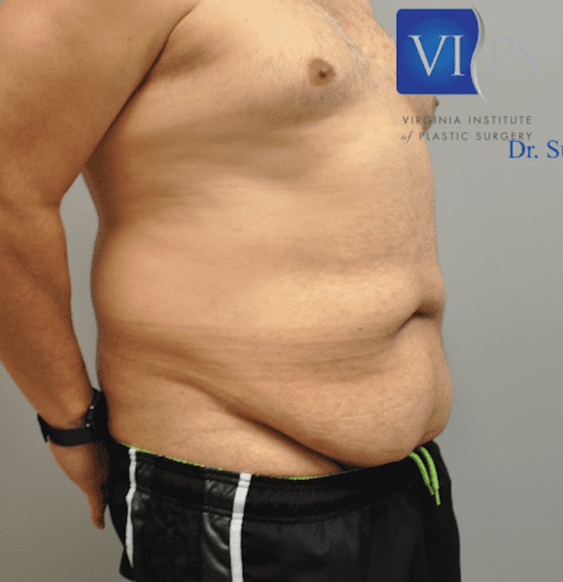 Tummy Tuck Before & After Gallery - Patient 55345753 - Image 3