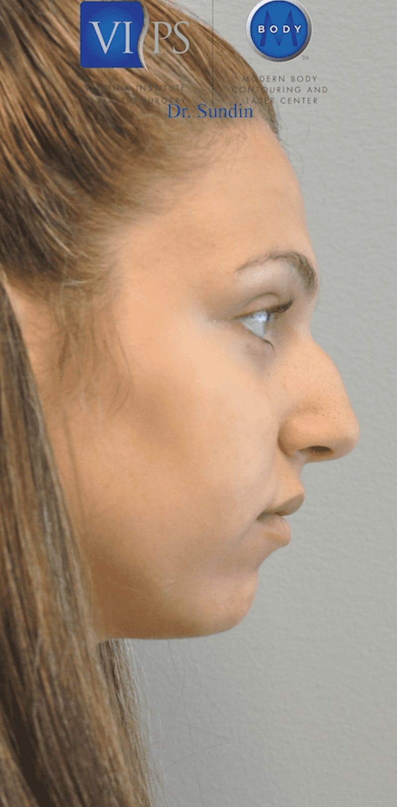 Rhinoplasty Before & After Gallery - Patient 55345754 - Image 5