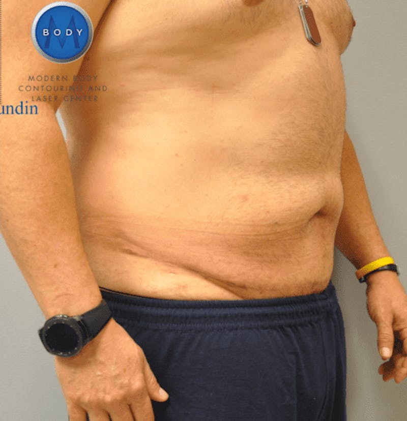 Tummy Tuck Before & After Gallery - Patient 55345753 - Image 4