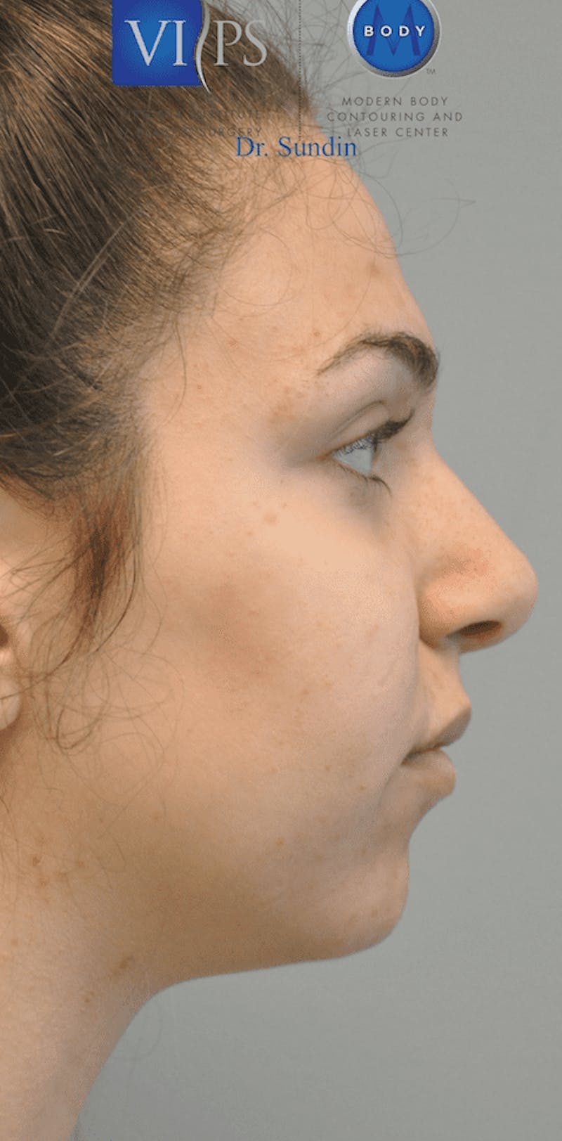 Rhinoplasty Before & After Gallery - Patient 55345754 - Image 6