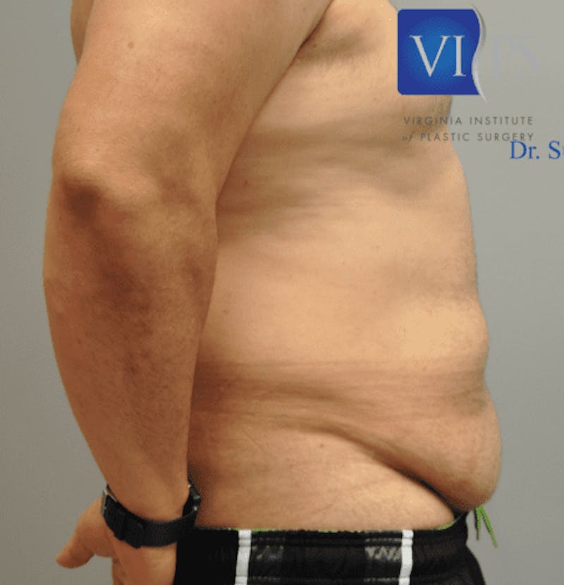 Tummy Tuck Before & After Gallery - Patient 55345753 - Image 5