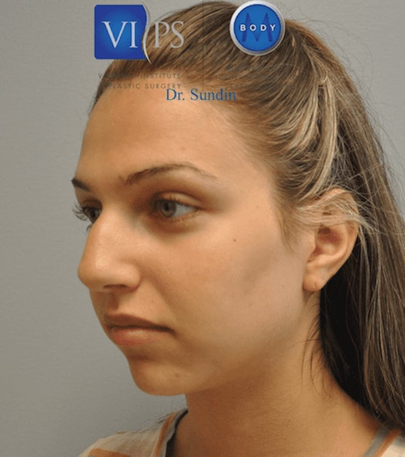 Rhinoplasty Before & After Gallery - Patient 55345754 - Image 7