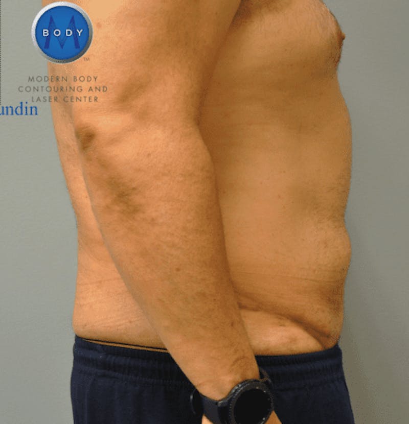 Tummy Tuck Before & After Gallery - Patient 55345753 - Image 6