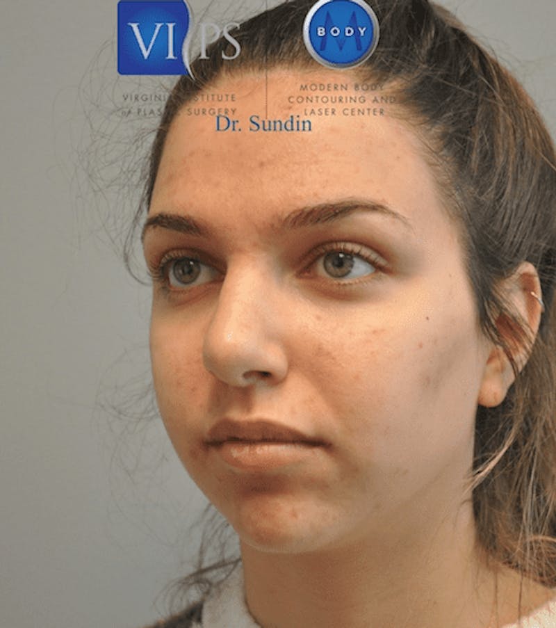 Rhinoplasty Before & After Gallery - Patient 55345754 - Image 8