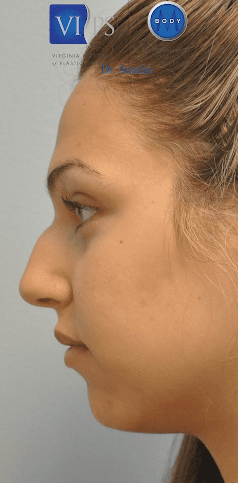 Rhinoplasty Before & After Gallery - Patient 55345754 - Image 9
