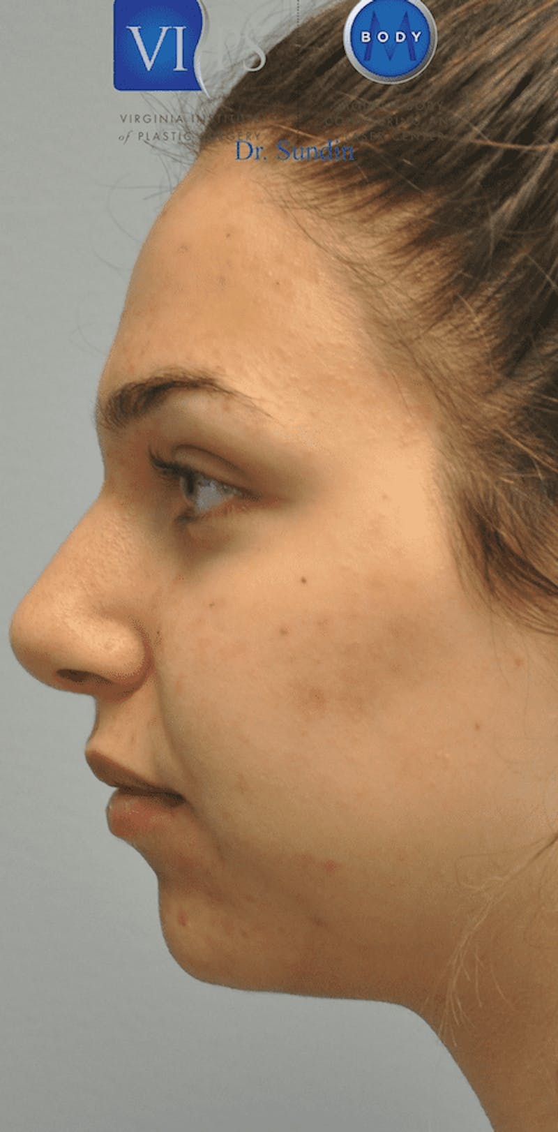 Rhinoplasty Before & After Gallery - Patient 55345754 - Image 10