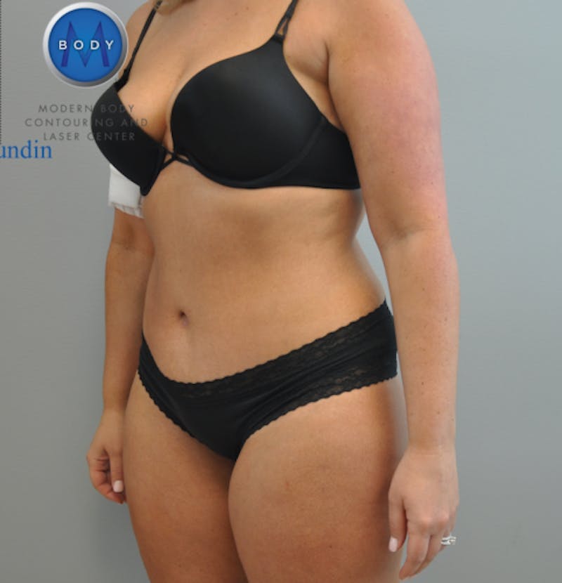 Tummy Tuck Before & After Gallery - Patient 55345309 - Image 6
