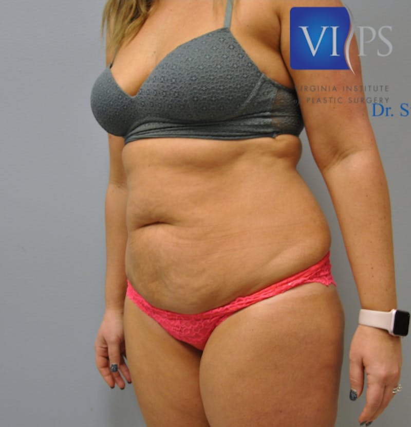 Tummy Tuck Before & After Gallery - Patient 55345309 - Image 5