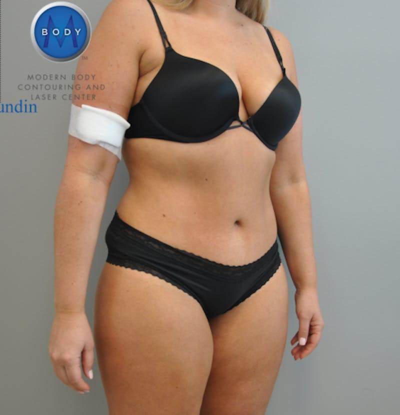 Tummy Tuck Before & After Gallery - Patient 55345309 - Image 8