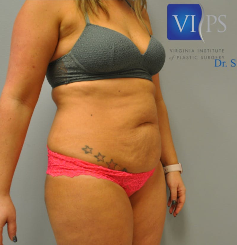 Tummy Tuck Before & After Gallery - Patient 55345309 - Image 7