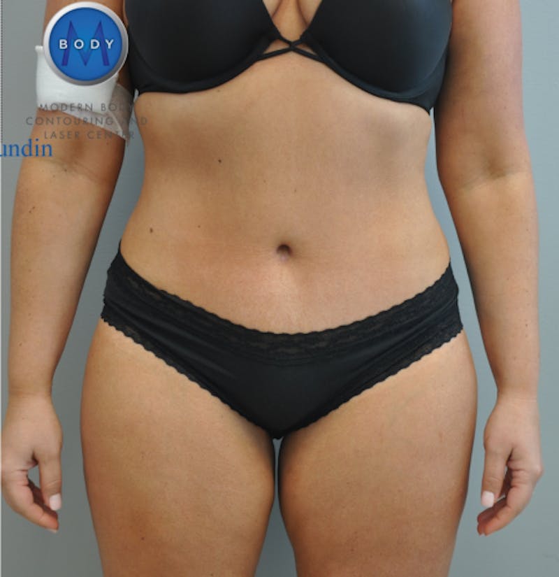 Tummy Tuck Before & After Gallery - Patient 55345309 - Image 2