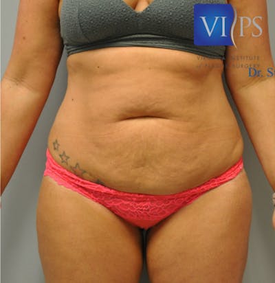 Tummy Tuck Before & After Gallery - Patient 55345309 - Image 1
